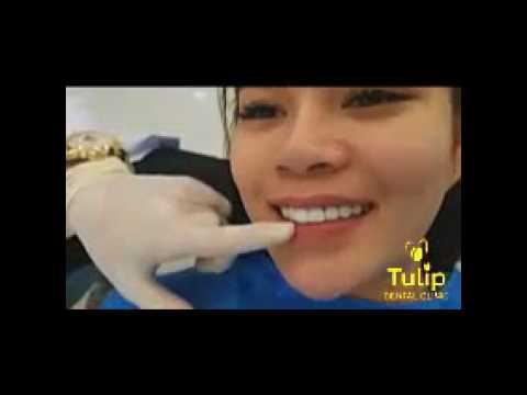 Quá Trình Bọc Răng Sứ Tại Nha Khoa Tulip