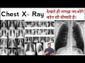 Chest X Ray X Ray X Ray Reading Pneumonia Lungs Effusion X Ray Technician Doctor Bhms