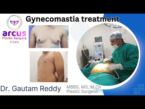 Gynecomastia (grade-2) Surgery in Hyderabad | Arcus Plastic Surgery Clinic.