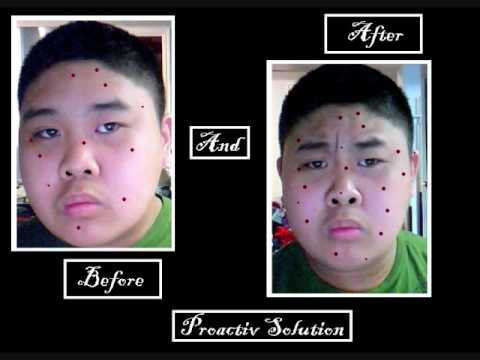 Ivory Acne Soap vs Proactiv Solution