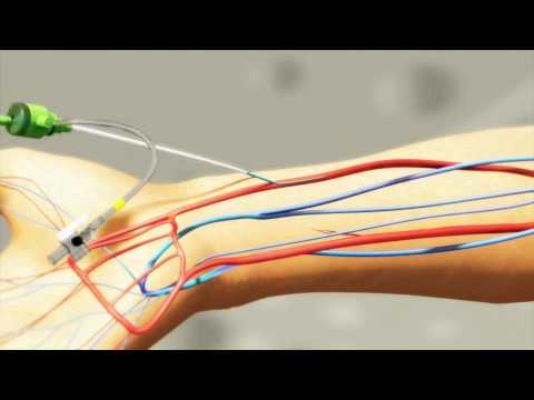 Radial artery puncture using the 'Insyte and Angiocath' technique