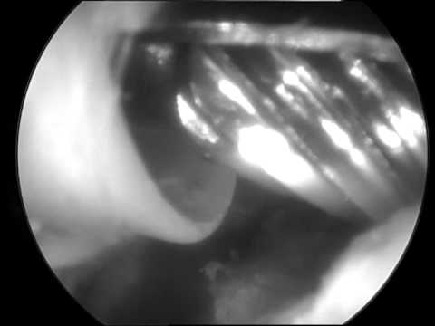 Osteofiti trattamento polso Quando ha fatto a raggi X delle articolazioni dellanca dei neonati