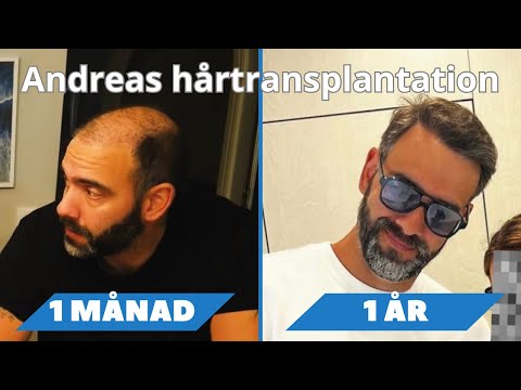 Andreas hårtransplantation: Före, operation, läkning, resultat