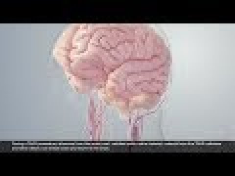 3D Animation of SENTINEL™ Cerebral Protection System