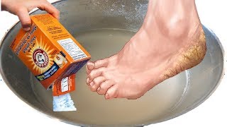 How To Use Baking Soda As A Treatment For Feet Calluses, Foot Odor, & Cracked Heels