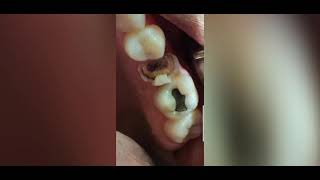 Removing a very rotten tooth, painless procedure