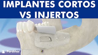 Los implantes cortos y el aumento óseo mandibular ©