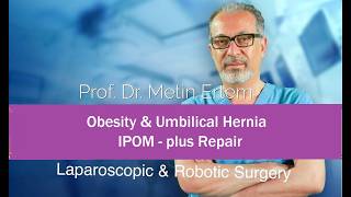 Miniaturka - Obesity & Umbilical Hernia. IPOM plus Repair. Metin Ertem MD.FACS