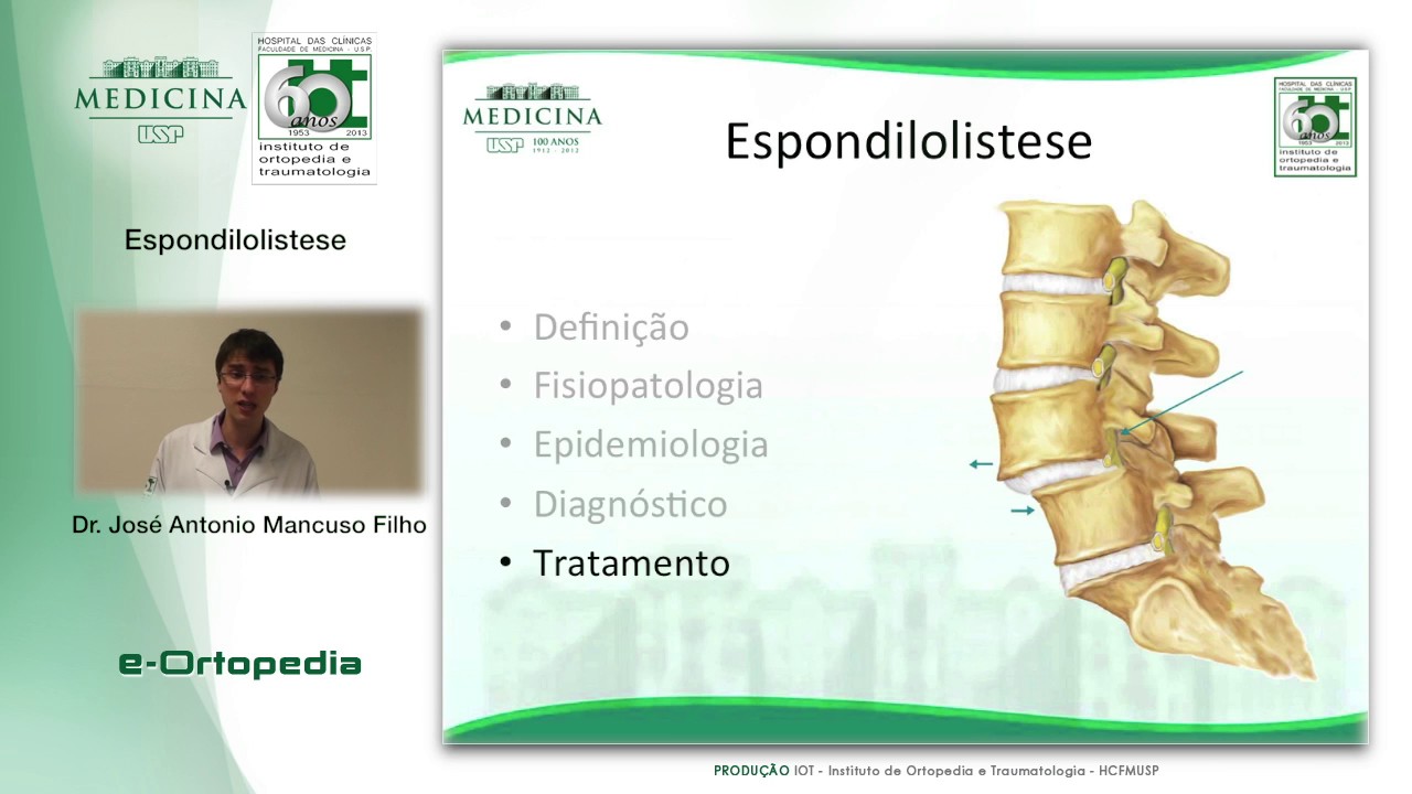 Espondilolistese - Dr. José Antonio Mancuso Filho