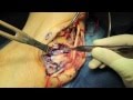 Live Surgery Cubital Tunnel, Ulnar Nerve Transposition, Decompression, at the Elbow.mov