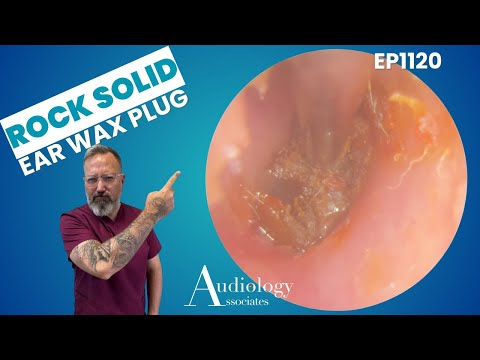 Rock Solid Ear Wax Plug! Deep & Stubborn Removal 😱👂  EP1120