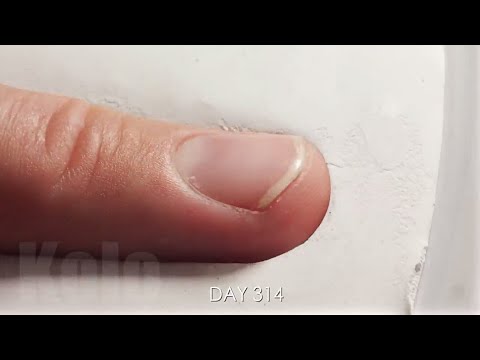 One Year Time Lapse of Growing-Trimming Fingernail