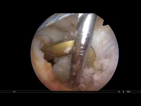 Deformierte acute Gonarthrose Behandlung von zervikaler Herniated manueller Therapie