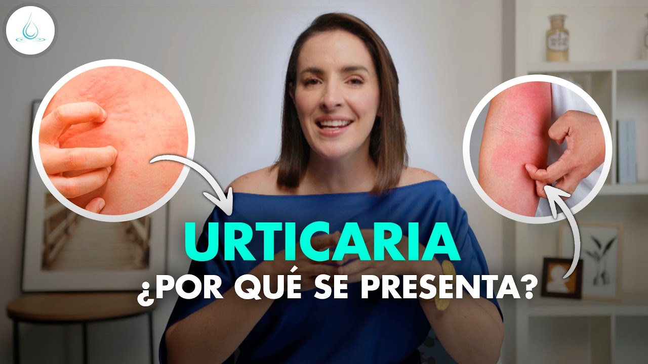 🔴 URTICARIA | Que es Sintomas y tratamiento! @drapilarochoa - Dermatologa