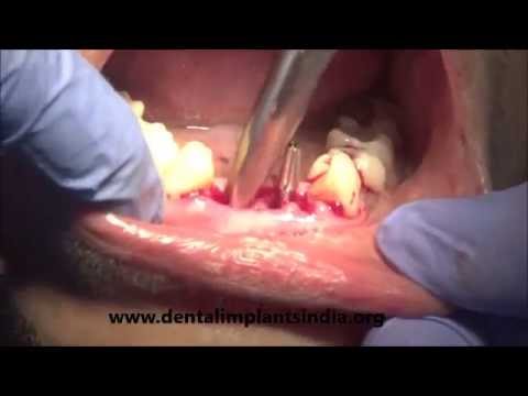 Lower incisor extraction and immediate bicortical screws ins...