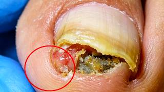 Curly Ingrown Toenails Are Buttoned Inwards And Trimmed【Xue Yidao】