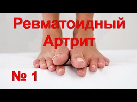 Ревматоидный артрит лечение без таблеток - № 1! Деформация пальцев ног. Как снять  боль в суставах