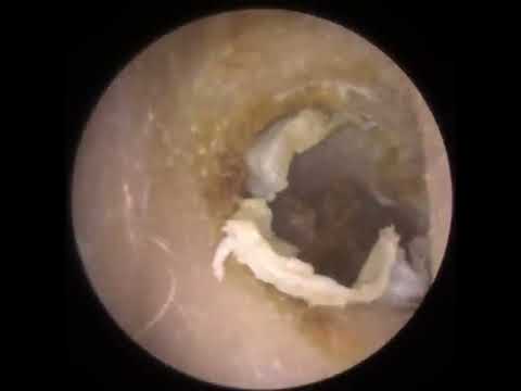 Ear wax removal | cera de ouvido | Ear #ear #earwax #cera #earwaxremoval