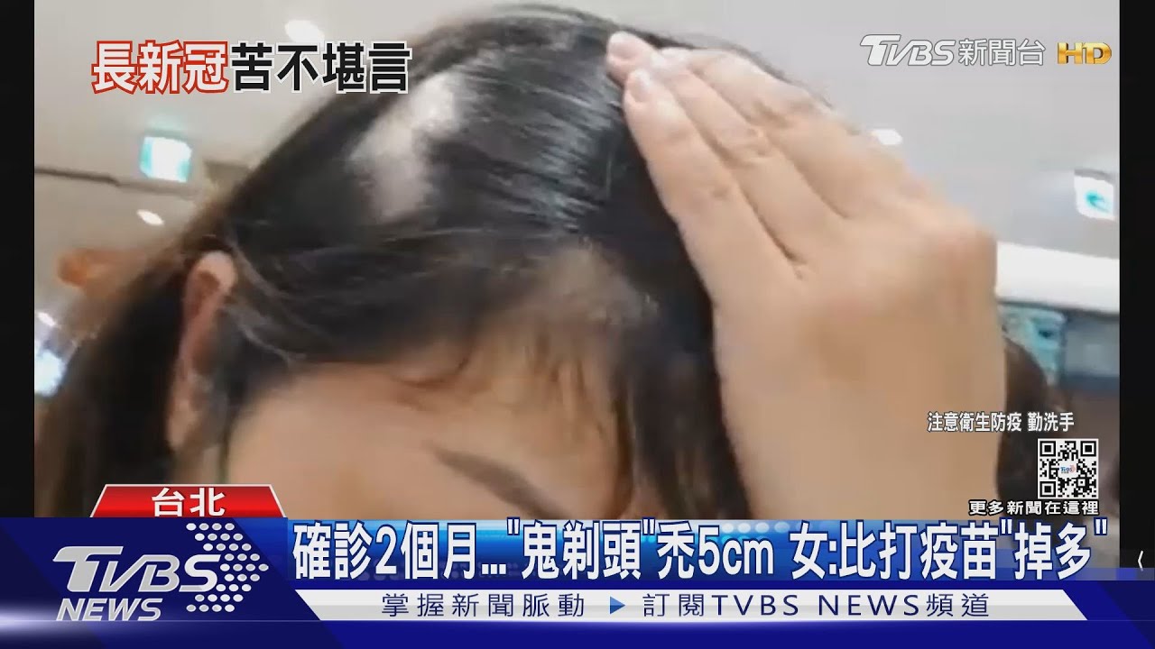確診2個月「鬼剃頭」禿5cm 女:比打疫苗「掉多」