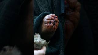 Jaime is impressed by Qyburn's treatment and thinks he's better than Pycelle