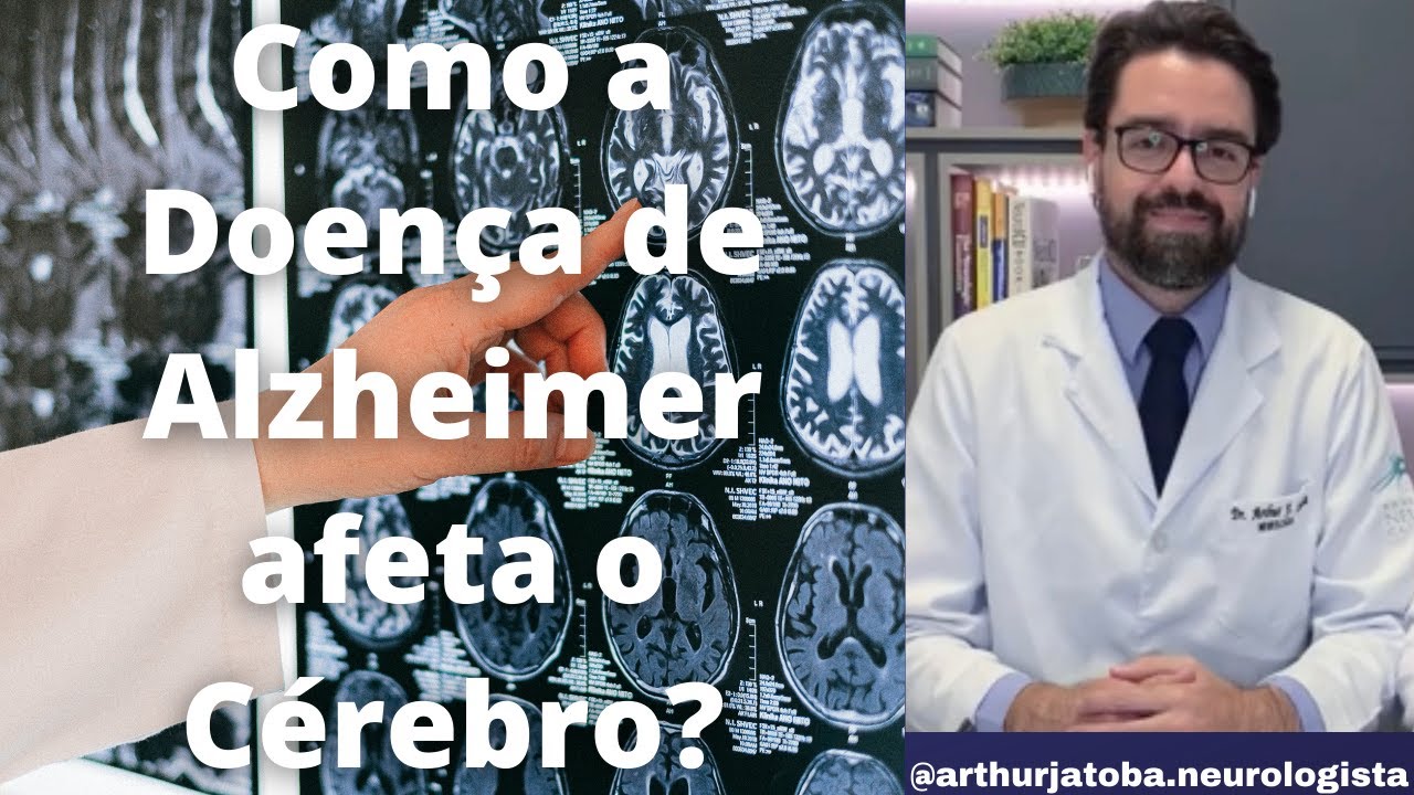ENTENDA COMO A DOENÇA DE ALZHEIMER AFETA O CÉREBRO