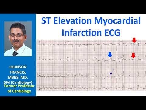 ST Elevation Myocardial Infarction ECG