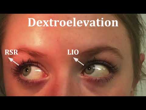 ORT5CLA Ocular Movements