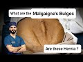 What Are Malgaigne S Bulges Dr Tayyab Riaz Ch