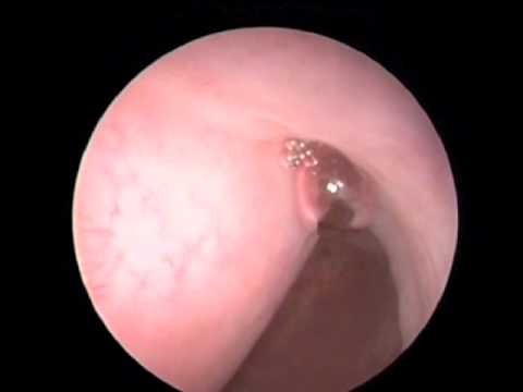 comment traiter un fibrome de 5 cm