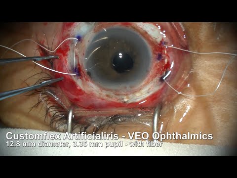 Sutured Artificial Iris and Intraocular Lens