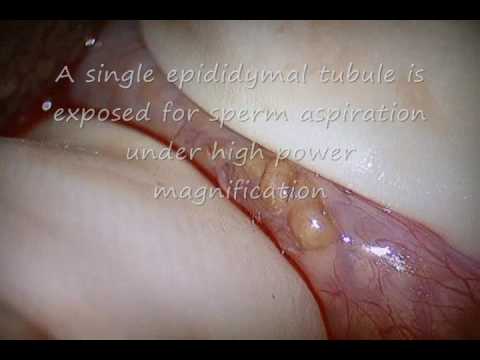 Microsurgical Epididymal Sperm Aspiration