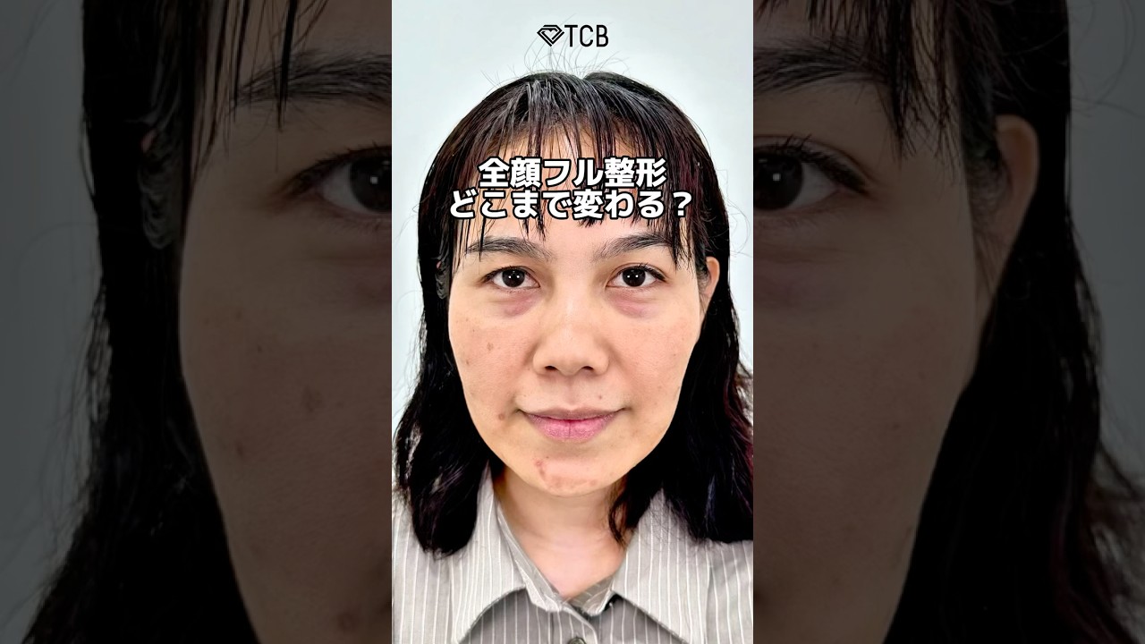 【クマ取り】全顔フル整形でどこまで変わる？#shorts