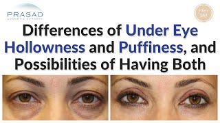 Important Differences Between Hollow and Puffy Eyes, and How they Can Both Occur