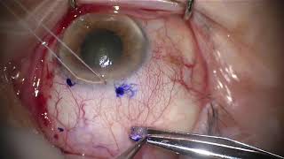 Pterygium Excision with Conjunctival Autograft