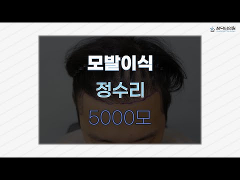 남자 정수리 모발이식 5,000모