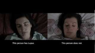 Download lagu Someone You Know May Have Lupus mp3 Download lagu Someone You Know May Have Lupus mp3
