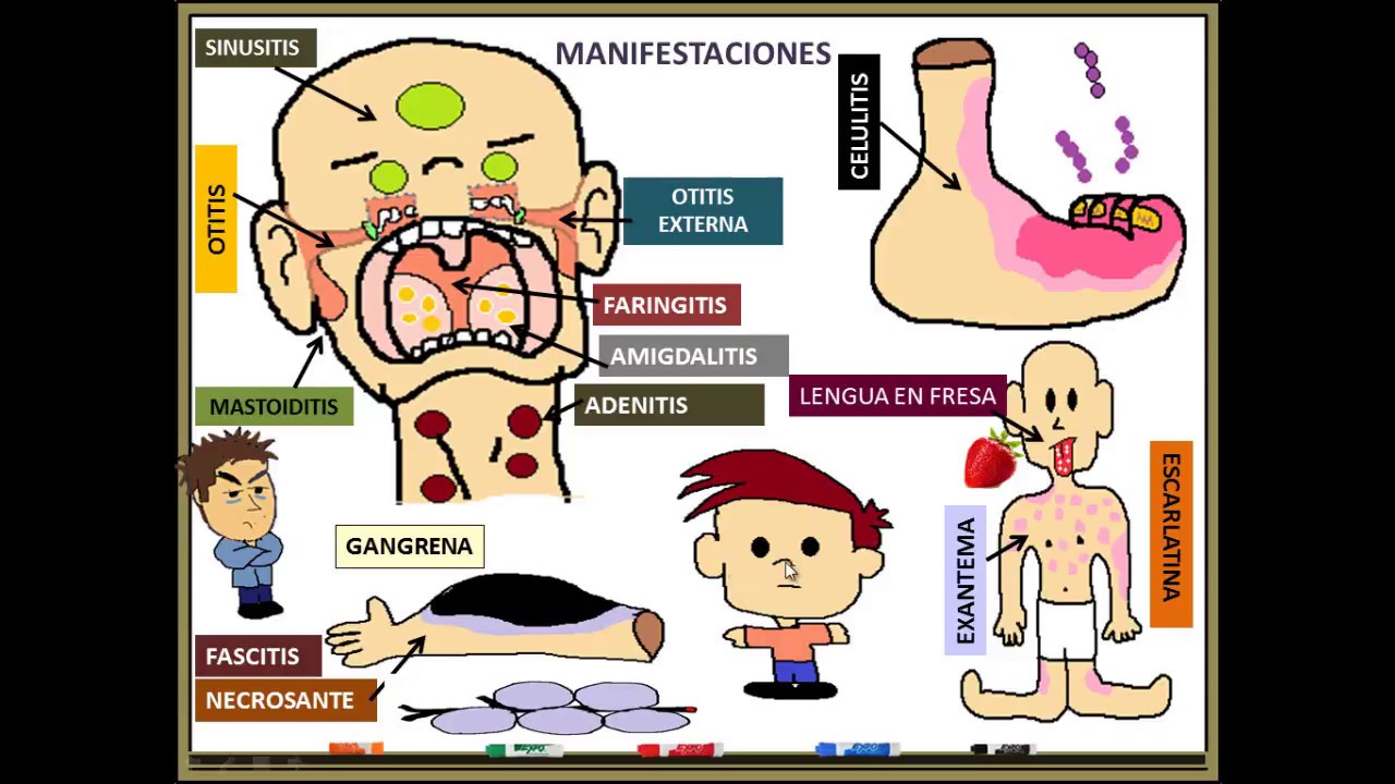 Estreptococo pyogenes