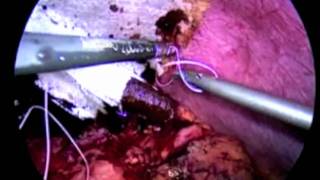 preview picture of video 'Laparoscopic Diaphragmatic Hernia Repair and Sutured Gastropexy for volvulus of stomach'