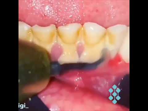 Limpieza Dental