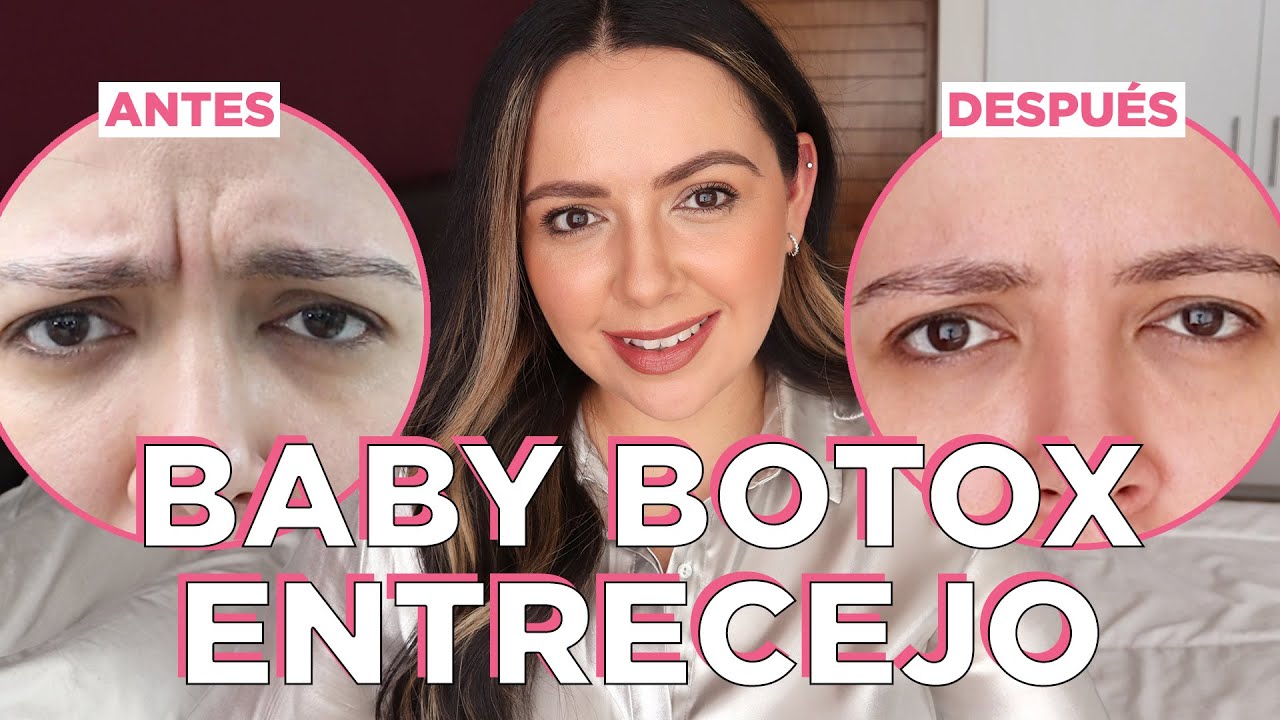 Baby Botox entrecejo para PREVENIR arrugas