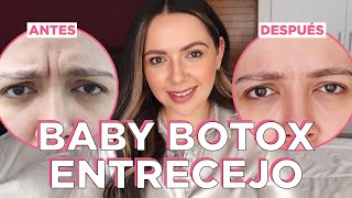 Baby Botox entrecejo para PREVENIR arrugas