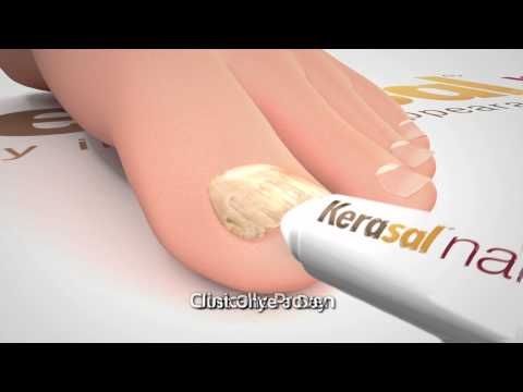 Modernong anti-fungal kuko sa paa Sakit ng kuko sa kamay ng isang doktor treats