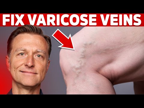 How to Treat Varicose Veins Naturally – Dr. Berg