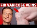 How to Treat Varicose Veins Naturally – Dr. Berg