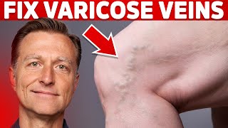 How to Treat Varicose Veins Naturally – Dr. Berg