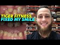 TigerFitness Fixed My Smile