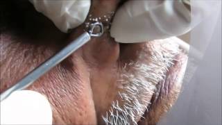 New Year 2016 Blackheads