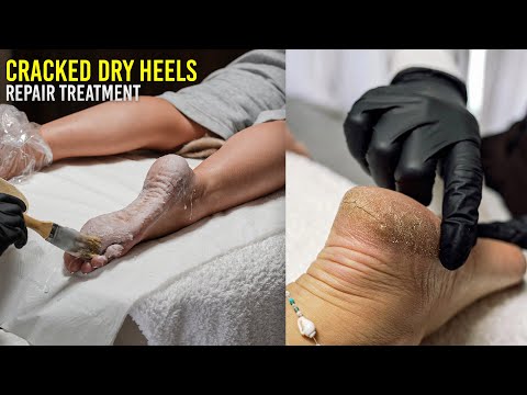 Satisfying Heel Restoration | Dry Cracked Feet Treatment