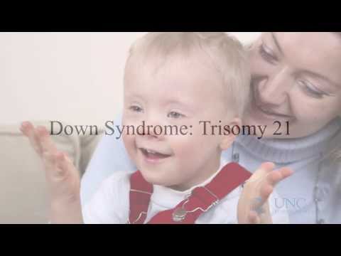 Down Syndrome:  Trisomy 21 Screening