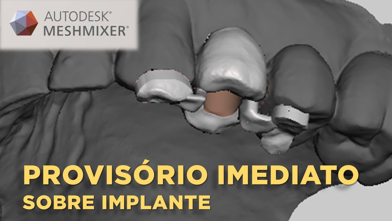 Provisorio Imediato para captura Sobre Implante - Meshmixer